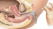 Laparoscopy Surgery Cost in Patna