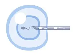 Fertilizing The Eggs process for IVF treatment