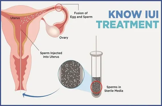 IUI Treatment Patna