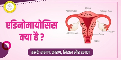 Adenomyosis Meaning in Hindi एडीनोमायोसिस क्या है और इलाज